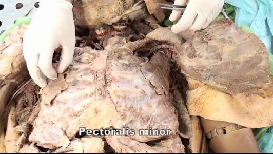 Anterior Thoracic Wall